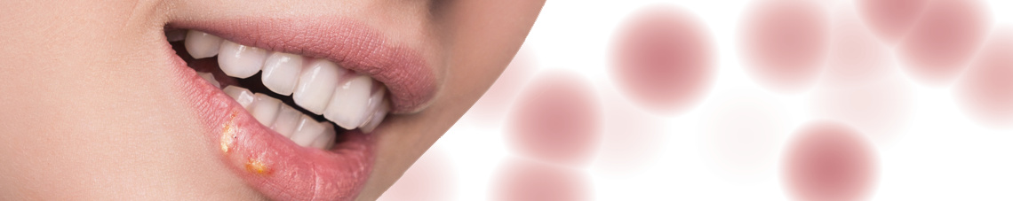 Lippenherps Abbildung für Hautarztpraxis Dr. Kautz in Konz